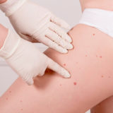 The girl has many moles on the skin, at the doctor. Prevention o